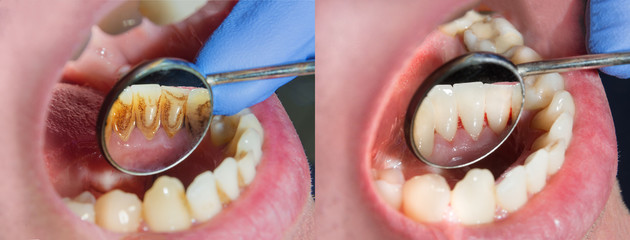 captura manzana Mucama Beneficios de una limpieza dental profesional - Bis Salud