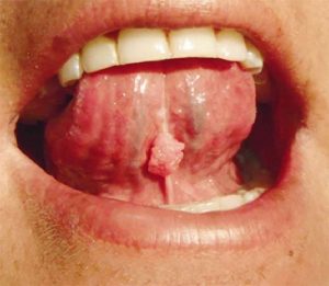 Persona con la lengua hacia arriba mostrando lesiones en el frenillo