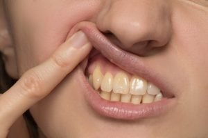 Manchas en los dientes - Mujer con dientes amarillos