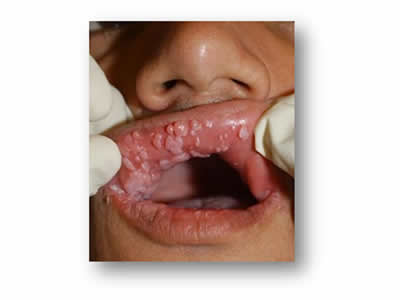 Papiloma escamoso en boca tratamiento, Papiloma escamoso boca