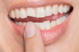 Traumatismo dental - Diente fracturado