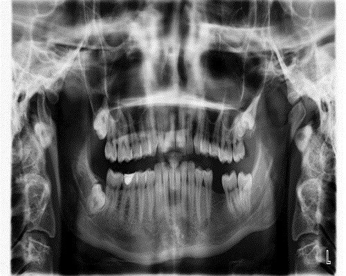 Radiografia dientes